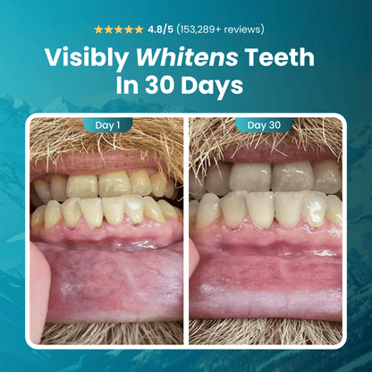 Side-by-side image of teeth before and after whitening treatment.