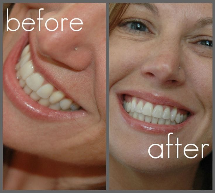 before and after teeth whitening.