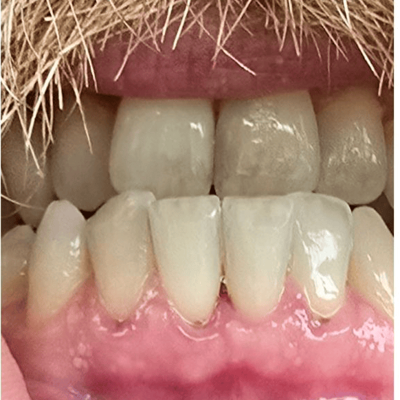 Dental crowns after procedure