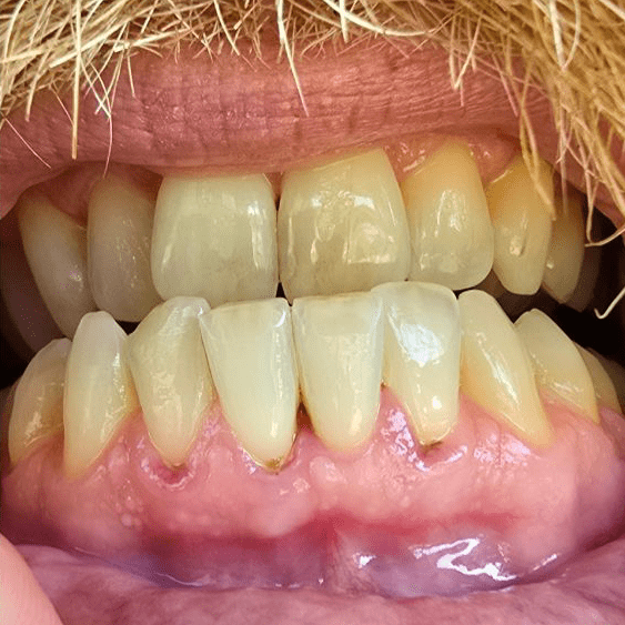 Close-up of teeth and gums